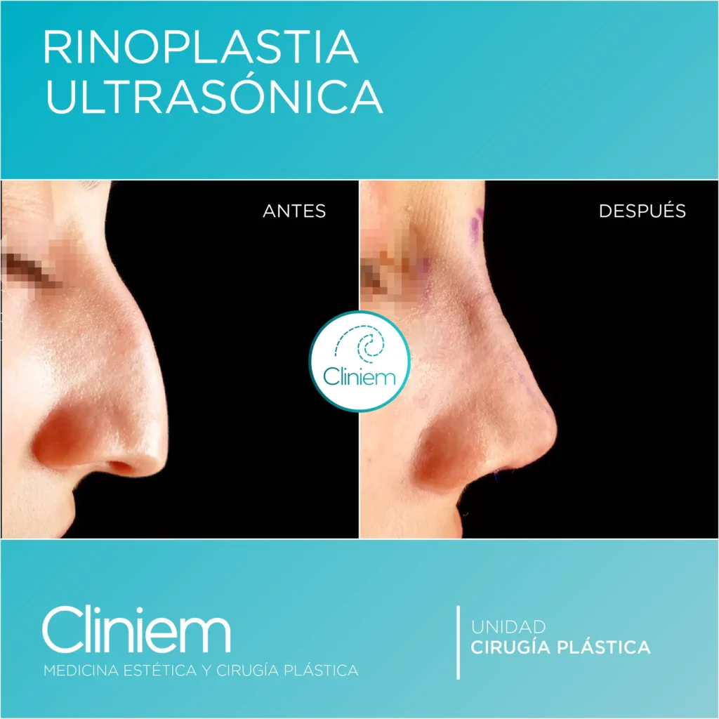 Rinoplastia en España: ¿Qué hace a una cirugía facial tan compleja y demandada?